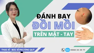 Cách trị ĐỒI MỒI trên mặt - tay | Phòng ngừa ĐỒI MỒI | Thạc sĩ - Bác sĩ Phương Quý