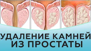 Удаление камней из простаты