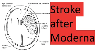 Stroke and death after Moderna