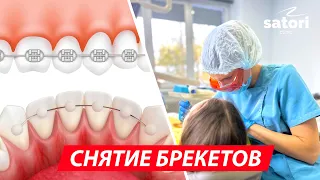 СНЯТИЕ БРЕКЕТОВ, РЕЗУЛЬТАТ ИСПРАВЛЕНИЯ ПРИКУСА #брекеты