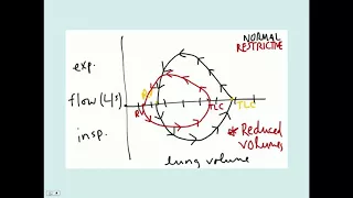 Interstitial Lung Disease - CRASH! Medical Review Series