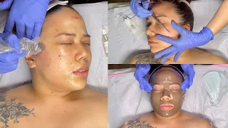 MICRONEEDLING FACIAL WITH DERMAPLANE | MY FIRST MICRONEEDLING TREATMENT | PREPARATION AND AFTERCARE