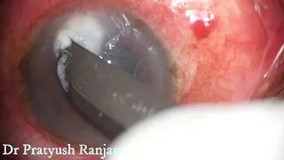 Therapeutic Corneal Ulcer Scraping