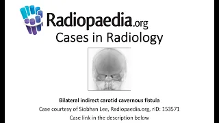 Bilateral indirect carotid cavernous fistula (Radiopaedia.org) Cases in Radiology