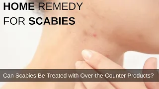 Home remedy for scabies | Can Scabies Be Treated with Over-the-Counter Products?