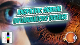 Idiopathic orbital inflammatory disease (Your EYEBALLS) 👁️👁️💉😳💊🔊💯✅