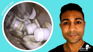1,503 - TOP 10 MOST BIZARRE FOREIGN BODY EAR EXTRACTIONS! 🫣