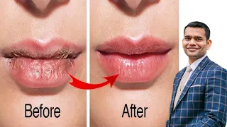 Get Pink And Baby Soft Lips Naturally At Home | Reasons For Dry Lips And it's Treatment