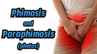 Phimosis and Paraphimosis (photos) - CRASH! Medical Review Series