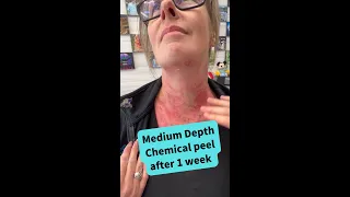 Medium Depth Chemical Peel at the dermatologist