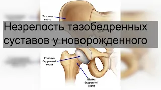 Незрелость тазобедренных суставов у новорожденного