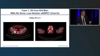 Novel Treatment Strategies and Latest Evidence for Metastatic Castration-Sensitive Prostate Cancer