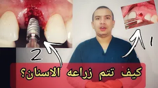 طريقتين لعمل زراعه الاسنان احدهما بدون جراحه في ٥ دقائق