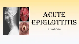 Acute epiglottitis - EMERGENCY condition, causes, clinical features, investigation, treatment