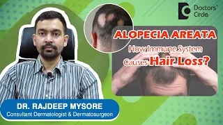 ALOPECIA AREATA & Triggers. How to prevent PATCHY HAIR LOSS? - Dr. Rajdeep Mysore | Doctors' Circle