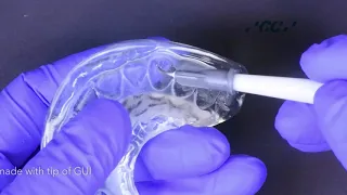 Injection moulding technique with GC Exaclear, Gaenial Universal Injectable