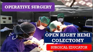 OPEN RIGHT HEMICOLECTOMY/  STEP BY STEP OPERATIVE SURGERY