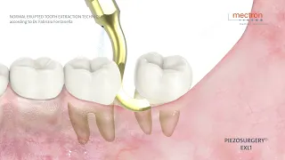 PIEZOSURGERY - ANIMATION - Normal erupted tooth extraction technique  Dr. Fabrizio Fontanella