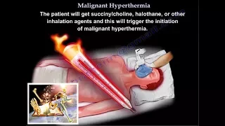 Malignant Hyperthermia - Everything You Need To Know - Dr. Nabil Ebraheim
