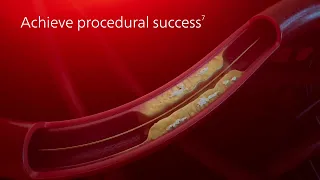 Philips Coronary Laser Atherectomy Catheter - ELCA  Mechanism of Action