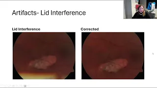 Lecture: The Fundamentals of Ophthalmic Fundus Photography