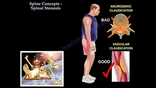 Spinal Stenosis - Everything You Need To Know - Dr. Nabil Ebraheim