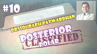 Commented 10: Posterior polar cataract at 50cm IOP Dr Sourabh Patwardhan