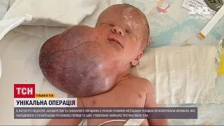 В Україні вперше успішно прооперували немовля з пухлиною розміром з голову | ТСН 16:45