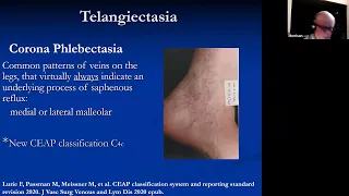 Visual and Ultrasound Guided Sclerotherapy Liquid and Foam | Grand Rounds 12.9.2022