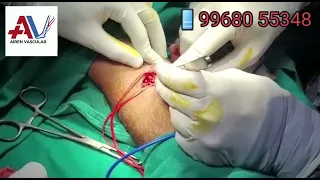 correct technique of av fistula