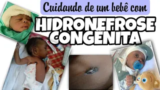 Ele nasceu com hidronefrose congênita + Pielostomia + Cuidados  com ele após a cirurgia ❤️