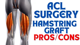 Pros and Cons of a Hamstring Graft for ACL Reconstruction Surgery
