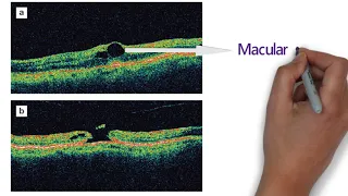 Optical Coherence Tomography - OCT | part-2