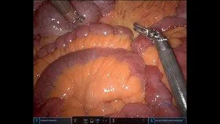 RNY distalization and cholecystectomy