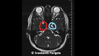 Tolosa Hunt Syndrome - MRI Brain