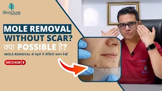 Mole removal without scar? | Best Mole removal Treatment in Delhi | Laser mole removal | Dr Jangid