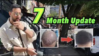 7 Month Hair Transplant Update from Turkey | CROWN GROWTH | #hairtransplant #veraclinic