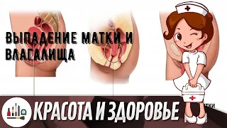 Выпадение матки и влагалища