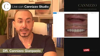 impianti senza osso. Denti fissi in 1 giorno