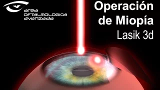 OPERACIÓN de MIOPIA LASER en 3D - Área Oftalmológica Avanzada