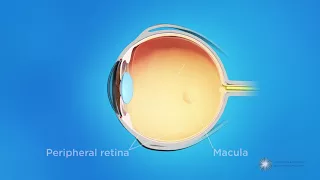 What is retinopathy of prematurity (ROP)?