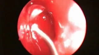 Drainage of Subperiosteal Abscess, FESS