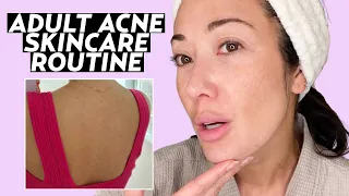 Skincare Routine for Adult Acne & Rosacea! | Susan Yara