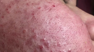 [Mai 1.2] Inflammatory acne treatment for Mai part 1 section 2 | 30/12/2019