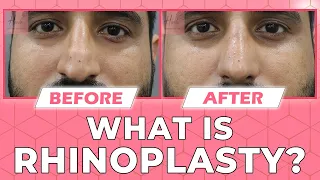 ✳️ What is Rhinoplasty? Rhinoplasty Procedure | Before and After Results of Rhinoplasty