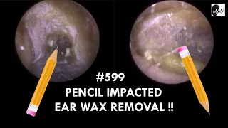 599 - PENCIL IMPACTED EAR WAX REMOVAL !!