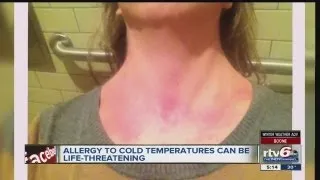 Noblesville woman suffers from rare allergy to cold weather