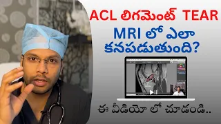 ACL Tear - How to see on MRI? Knee ligament tear | Knee instability - Dr Ramprasad Kancherla