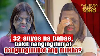 Babae, bakit nangingitim at nangungulubot ang mukha? | Kapuso Mo, Jessica Soho