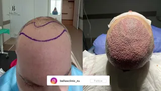 High density hair transplant / пересадка волос